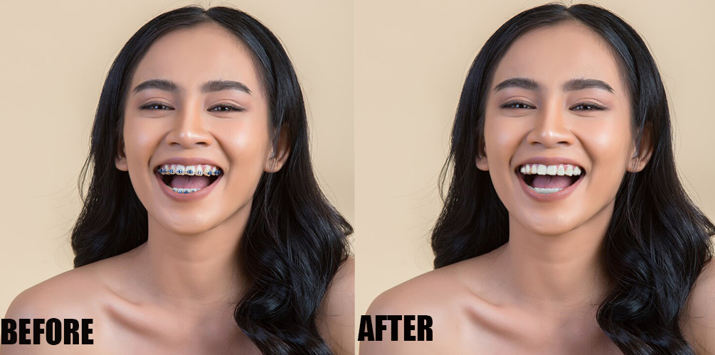 Photo-Editing-Company-Portrait-Brace-Removal